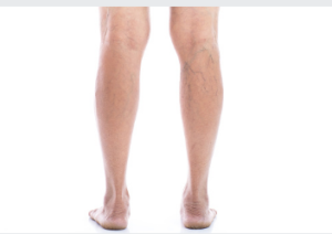 varicose vein removal Adelaide medical coverage